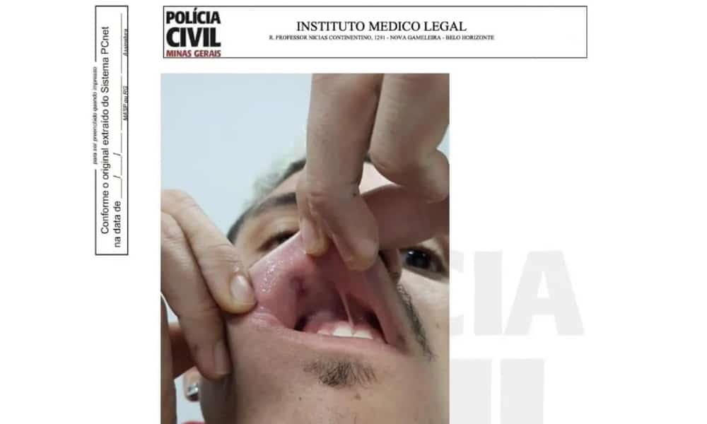 Pedro, atacante do Flamengo, mostra a boca ferida - (foto: Reprodução)
