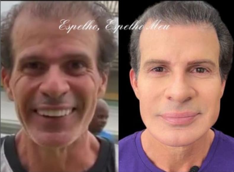 Antes e depois de harmonização facial de Túlio Maravilha (foto: Reprodução/Redes Sociais)