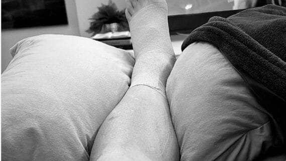 Soteldo publicou foto da lesão na perna esquerda, que o tirou do duelo diante do Atlético (foto: Redes sociais/Reprodução)
