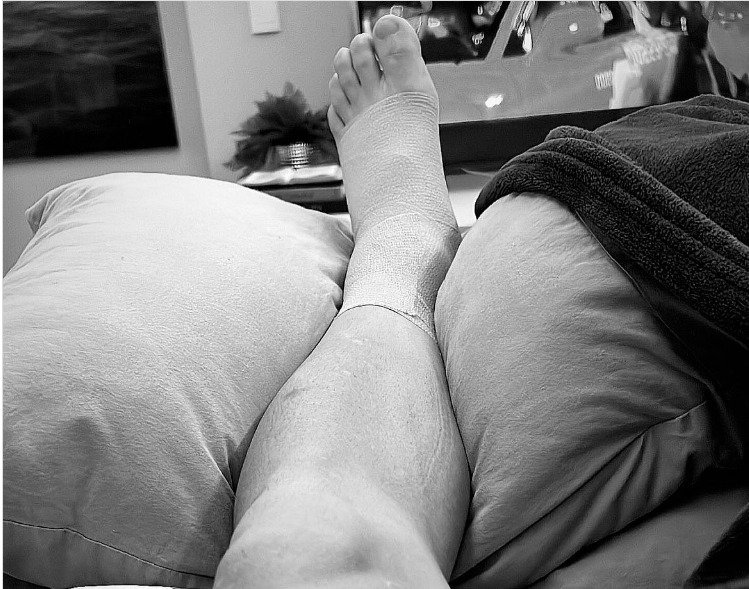 Soteldo publicou foto da lesão na perna esquerda, que o tirou do duelo diante do Atlético (foto: Redes sociais/Reprodução)