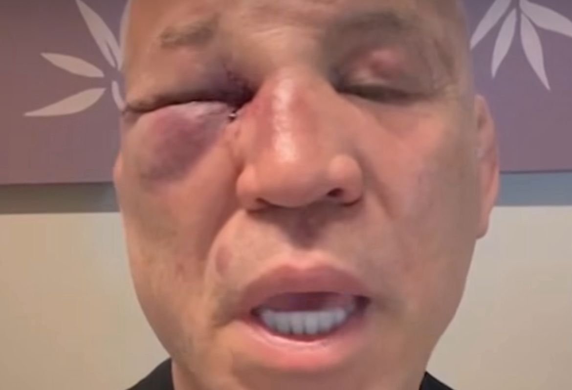 Wanderlei Silva fraturou o nariz e recebeu pontos nos olhos (foto: Reprodução/Instagram/Wanderlei Silva)