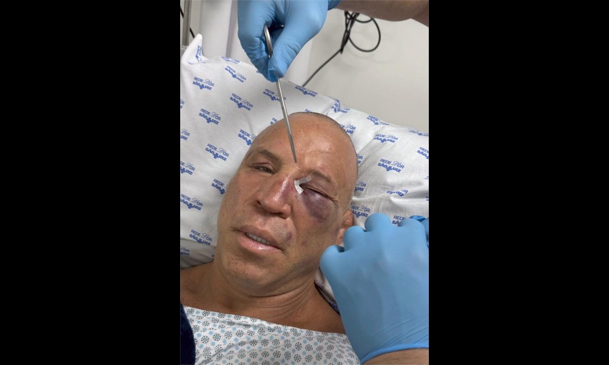 Wanderlei Silva fraturou o nariz e recebeu pontos nos olhos - (foto: Reprodução/Instagram)