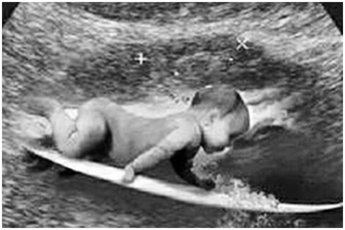 Montagem de um beê em uma prancha de surf em um ultrassom (foto: Divulgação/Gabriel Medina)